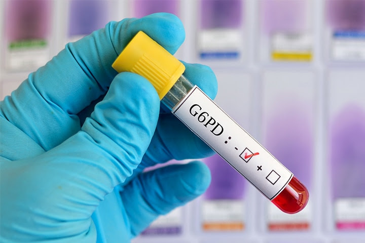 ¿La deficiencia de G6PD se relaciona con la infección por COVID-19?
