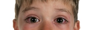 Nueva variante de COVID en el radar de la OMS que causa picazón en los ojos en los niños